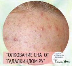 Прыщи по всему лицу во сне Прыщи по всему лицу во сне