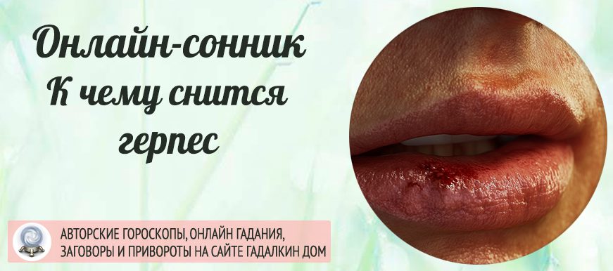 К чему снится герпес