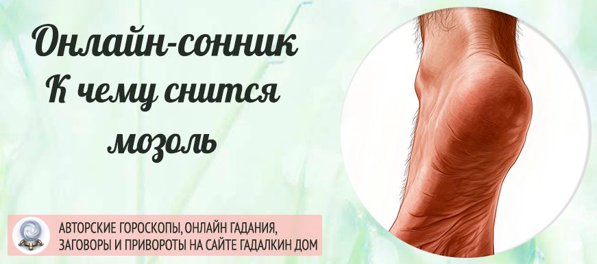 сонник мозоль